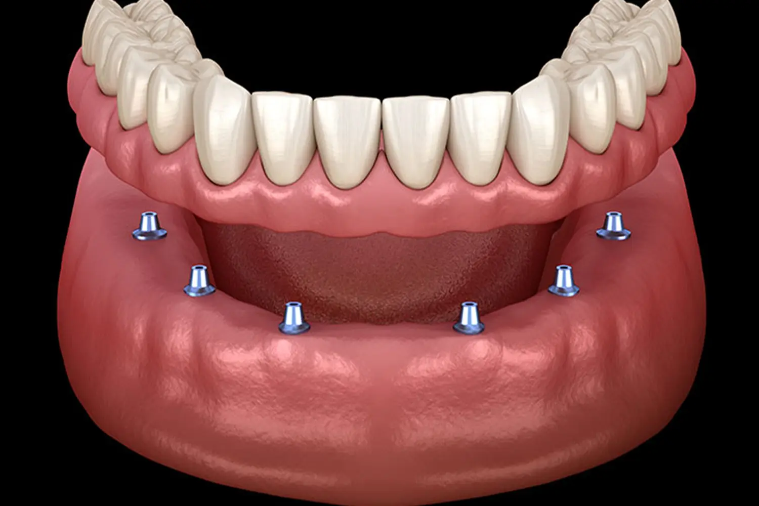 fixed-denture-implant-image